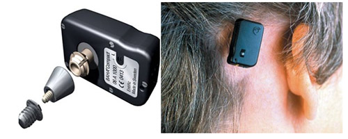 Имплантация системы костной проводимости BAHA