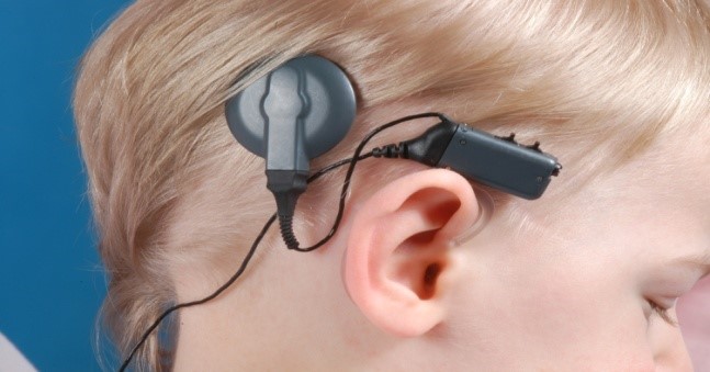 Кохлеарная имплантация