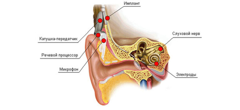 25 февраля 2026 года – Международный день кохлеарной имплантации (кохлеарного импланта)